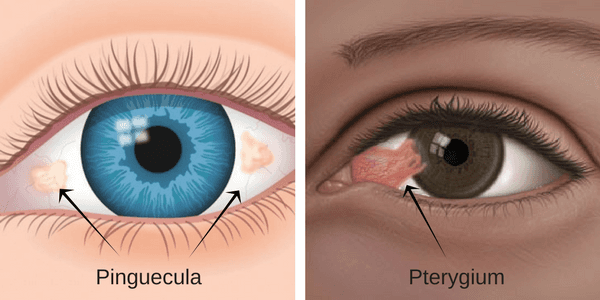 Pinguecula and Pterygium