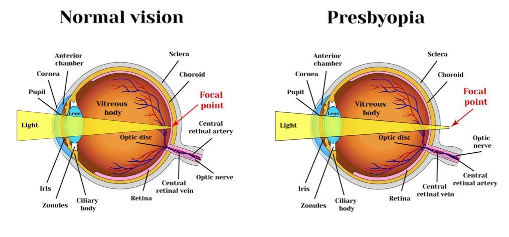 Diagram of normal eye and one with presbyopia