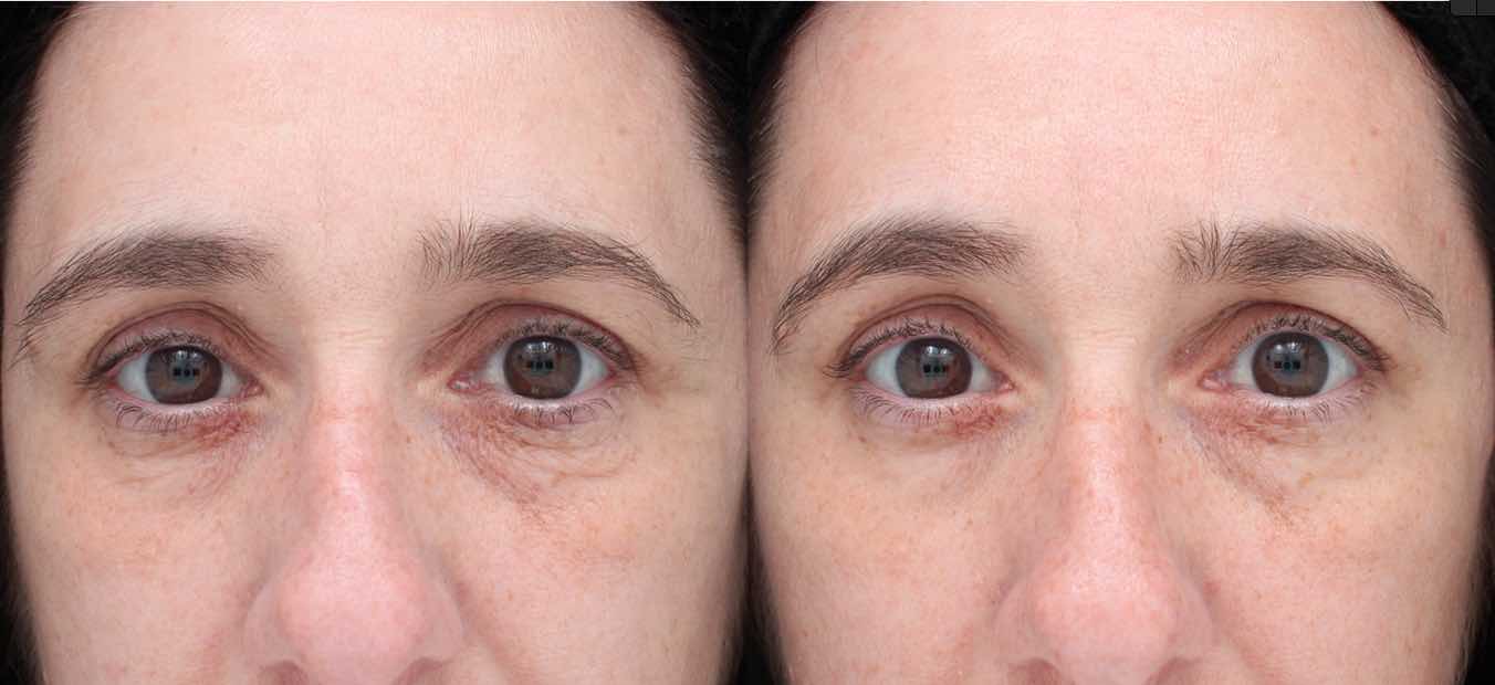 Eye area before and after treatment with TempSure Envi