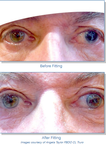 Patient before and after prosthetic lens fitting