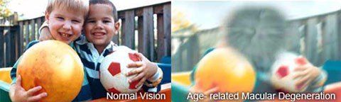 photographs comparing normal vision to that of someone with macular degeneration
