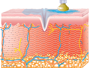 Graphic of  new collagen creation after using TempSure Envi