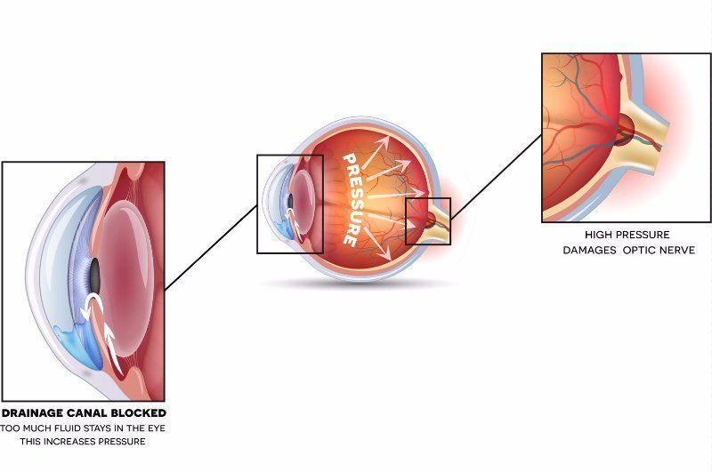 Damage to the optic nerve due to glaucoma