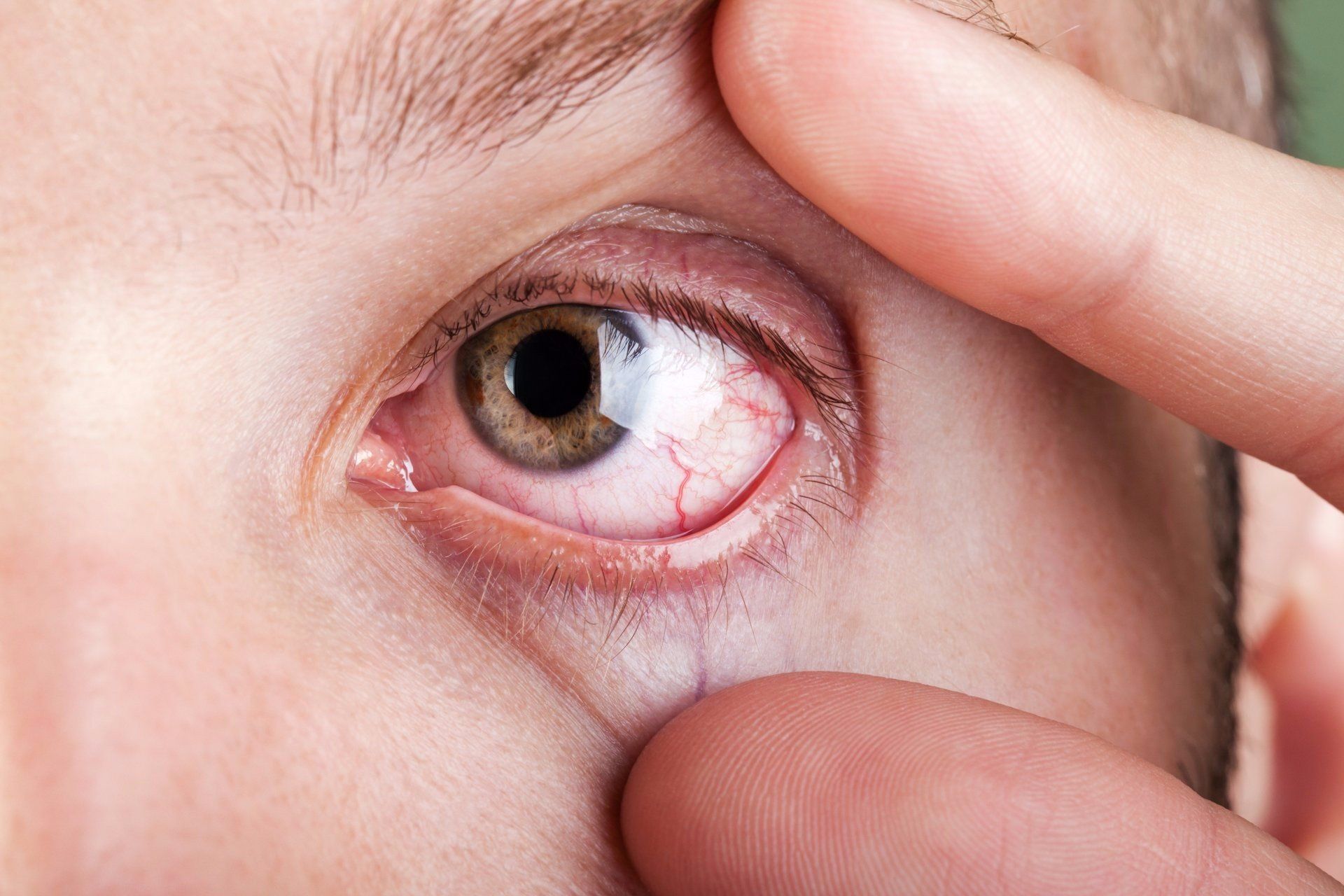 a close up of a person's red eye
