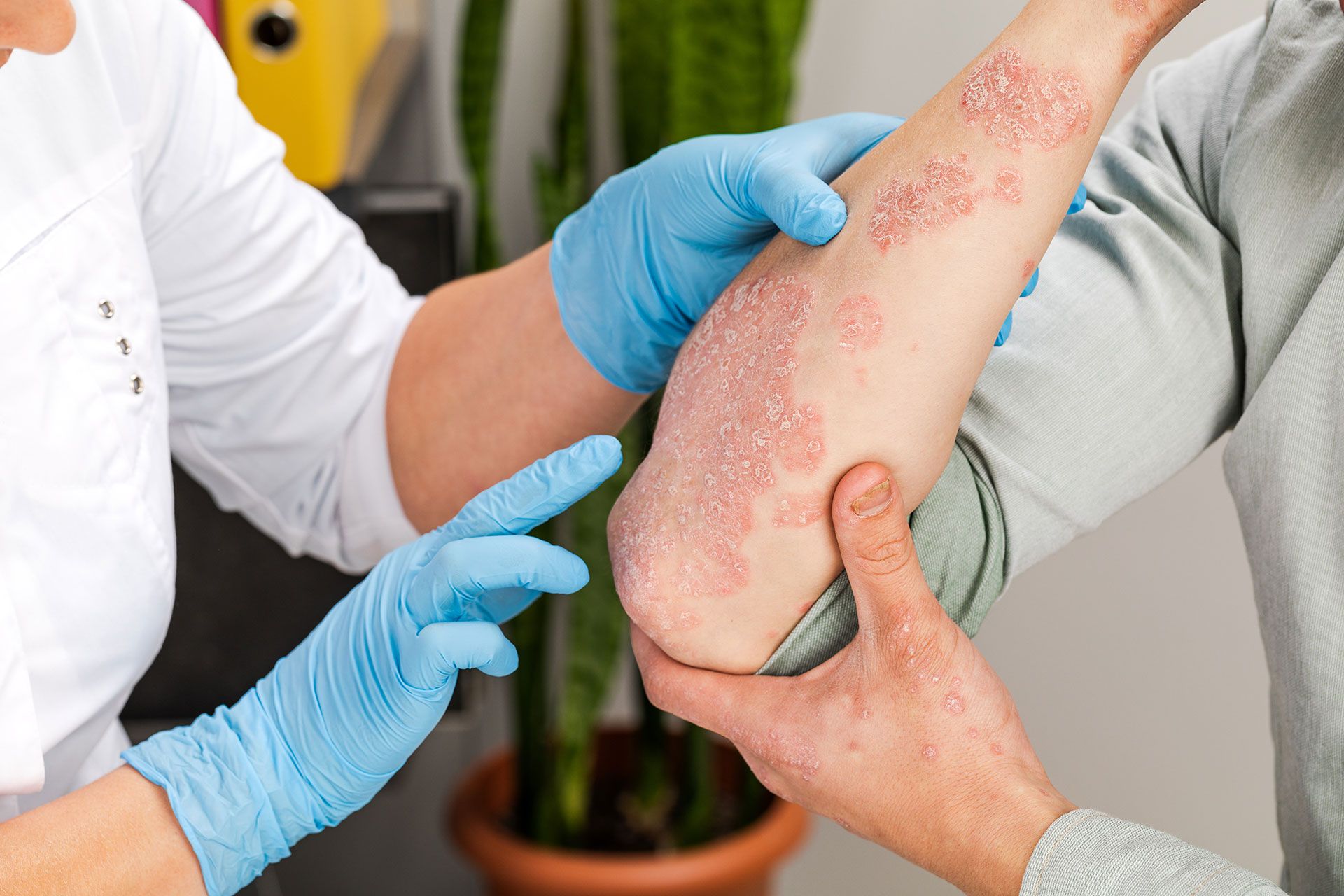 October is National Eczema Awareness Month: Understanding and Managing Your Skin
