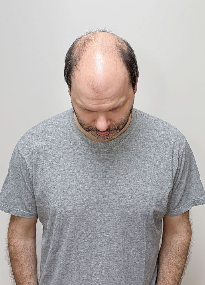 Hair Loss