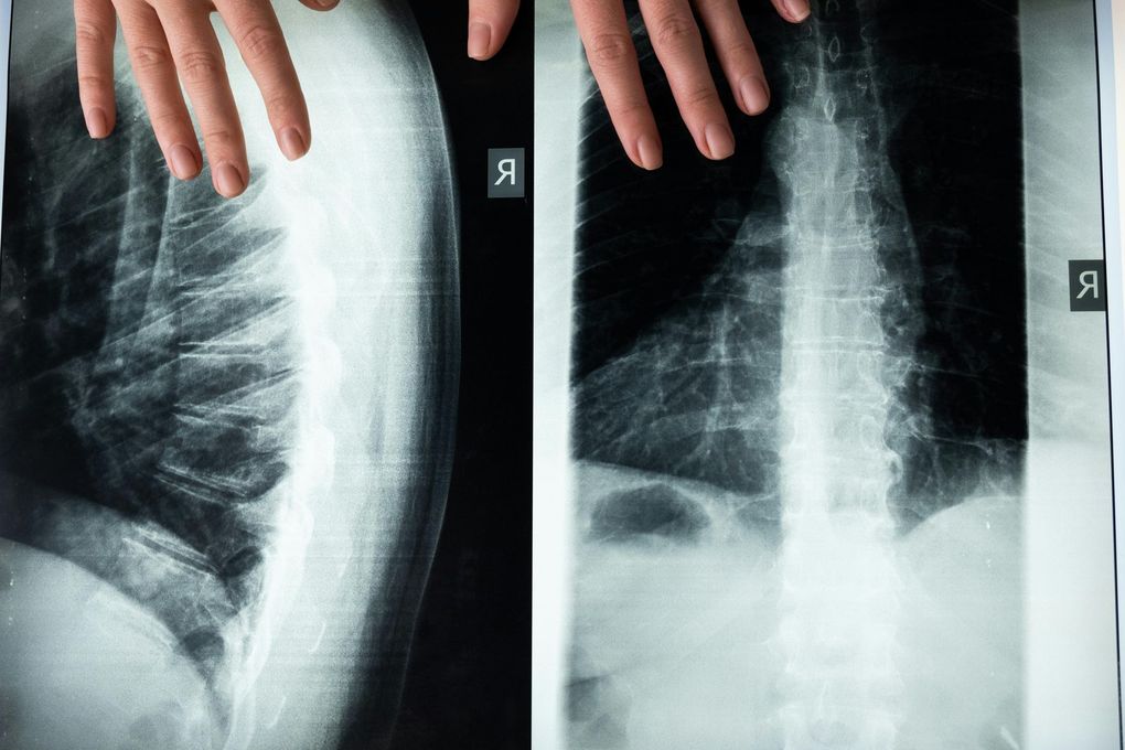 Two chest X-ray images, one side view and one front, with hands resting on the prints.
