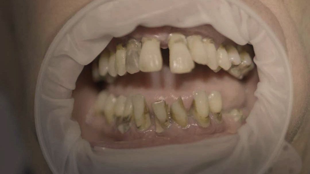 Daniele prima delle faccette