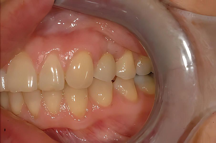 Daniele dopo le faccette