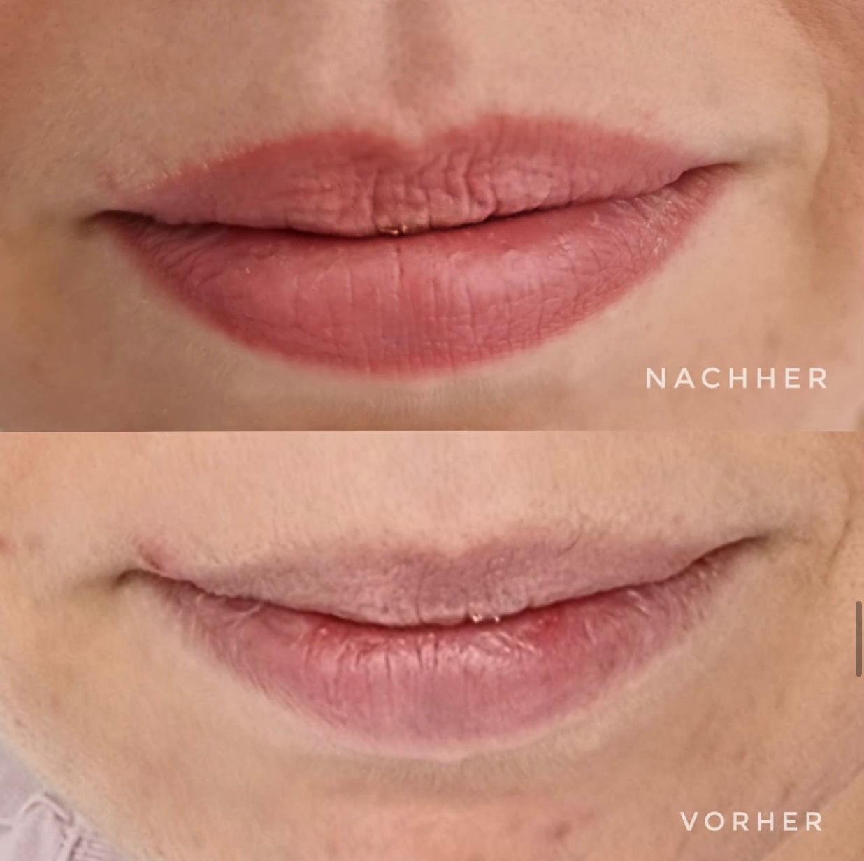Ein Vorher-Nachher-Bild der Lippen einer Frau.