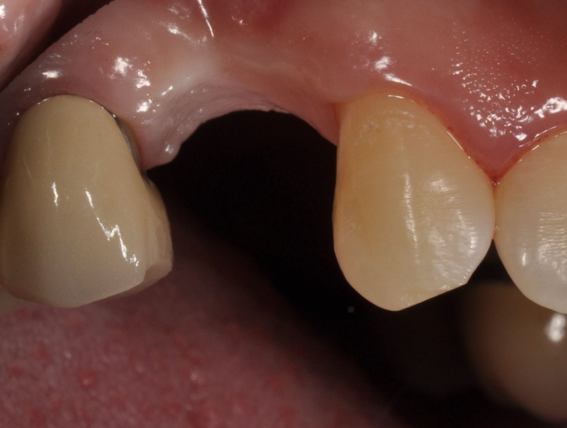 Single Tooth Implants: More Than Meets the Eye