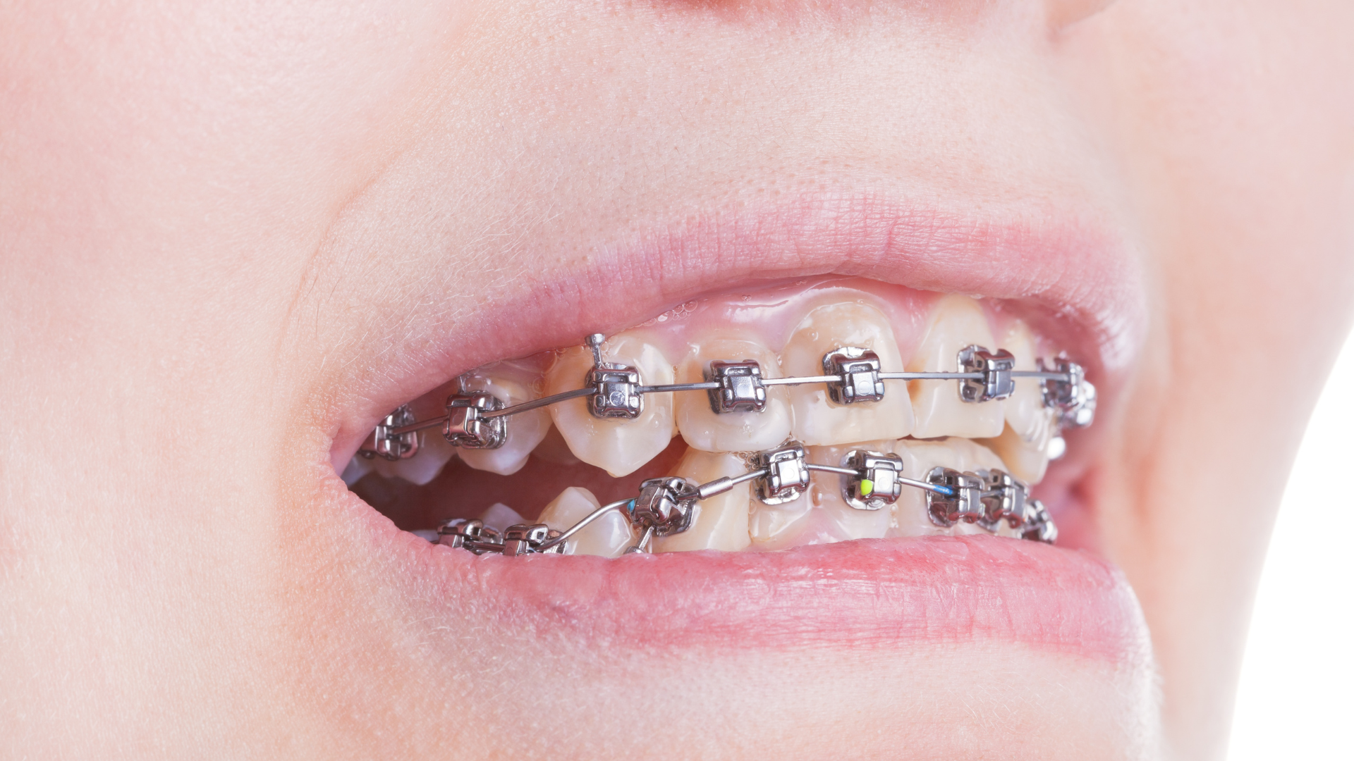 Braces (Orthodontia)