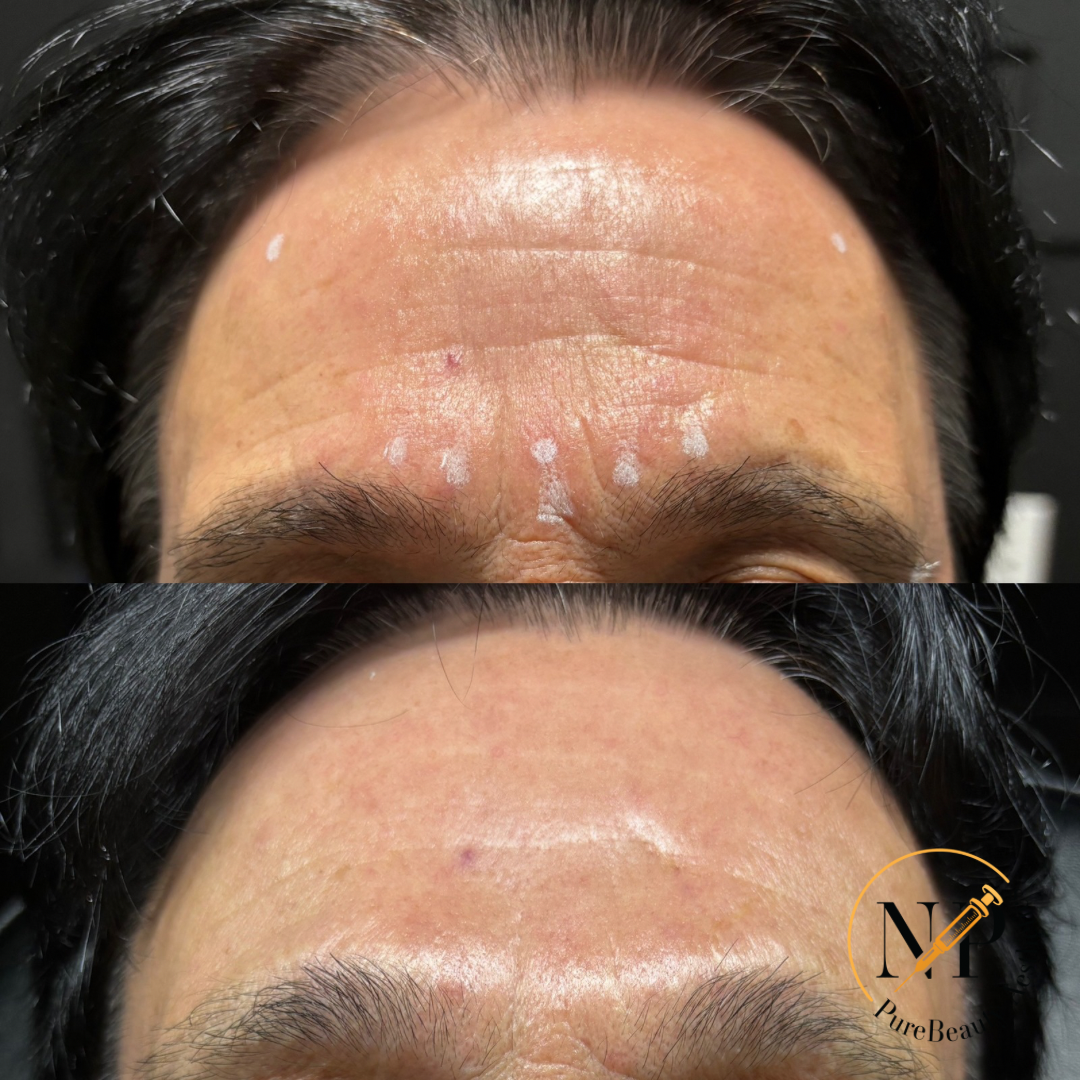 A before and after photo of a man 's forehead.
