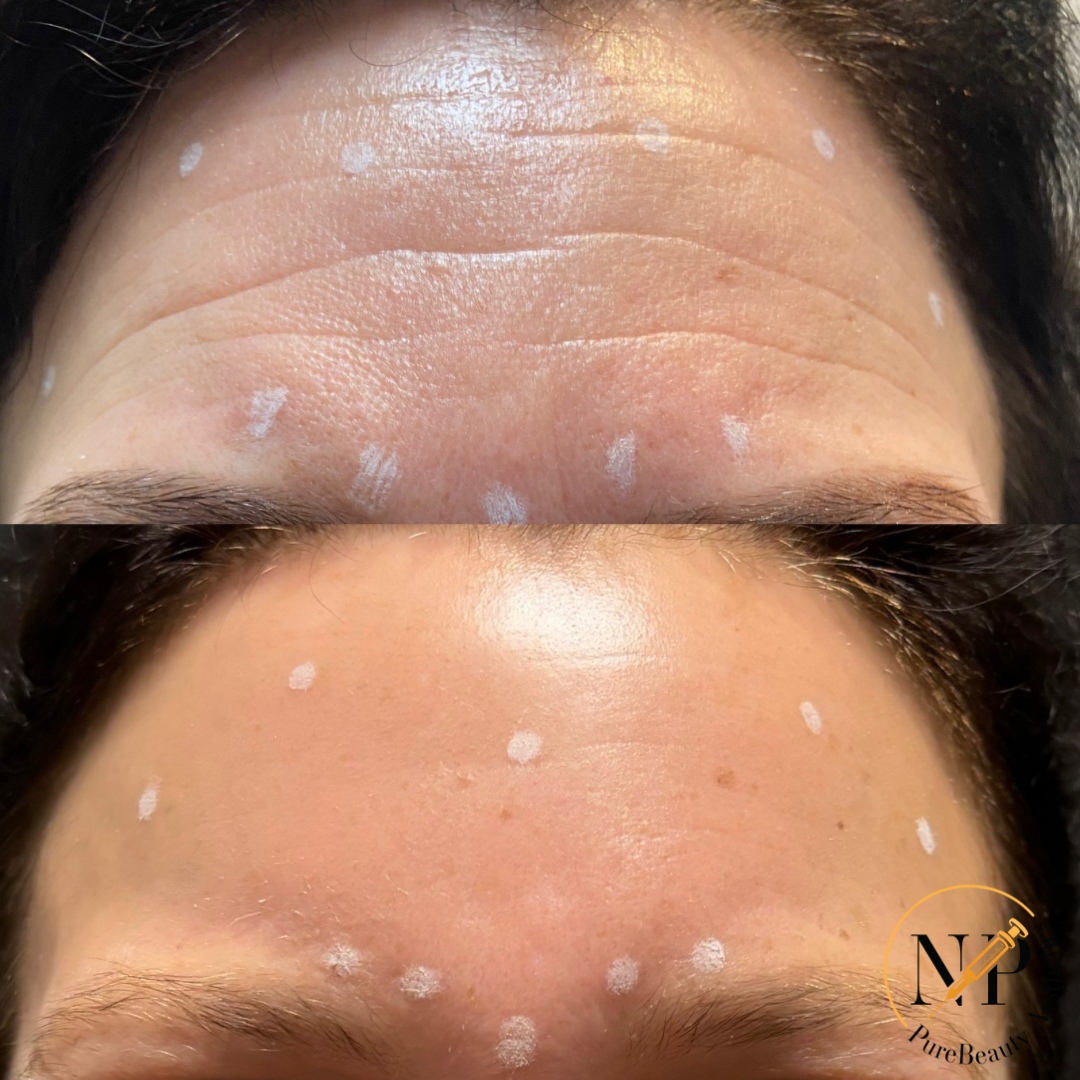 A woman 's forehead before and after botox injections.