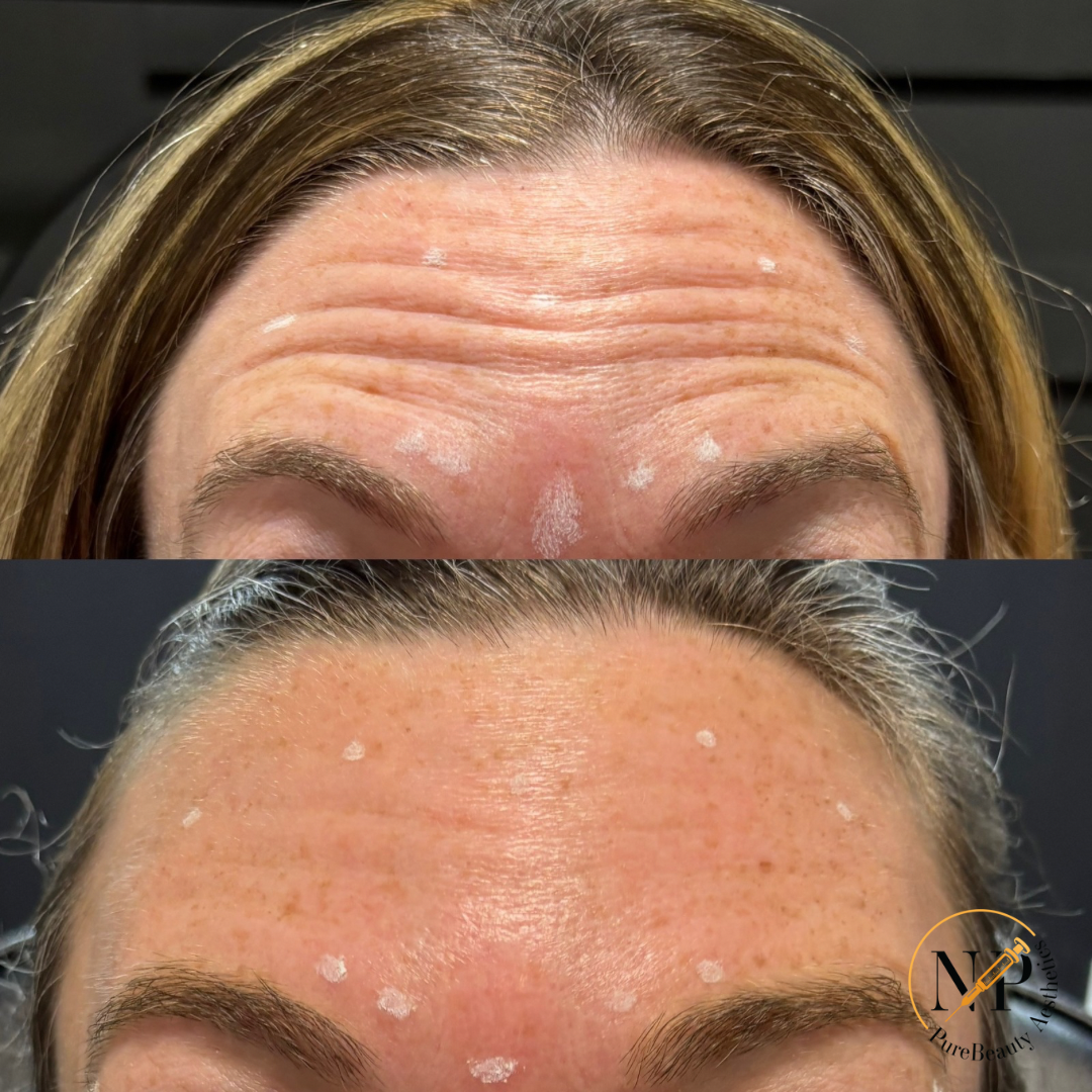 A woman 's forehead before and after botox injections.