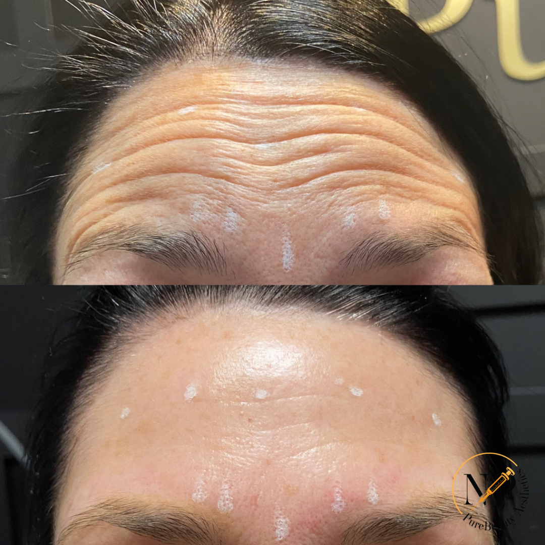 A woman 's forehead before and after botox injections.