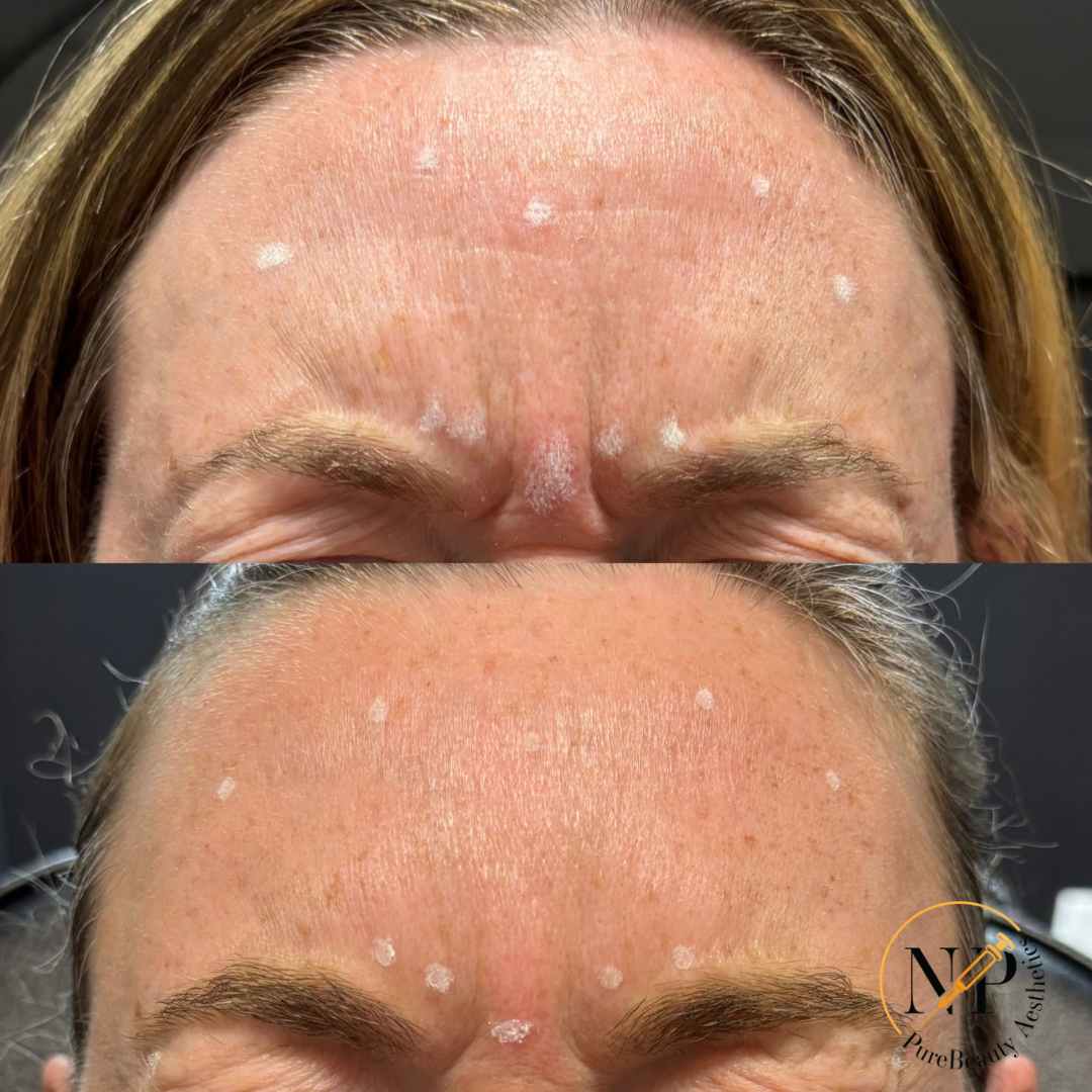 A before and after photo of a woman 's forehead with botox injections.