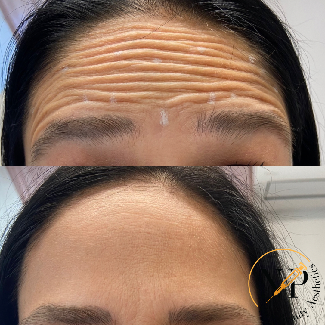 A before and after photo of a woman 's forehead with wrinkles.