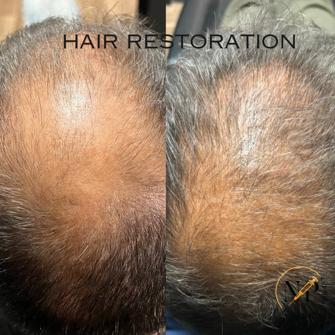 A before and after photo of a man 's hair restoration.