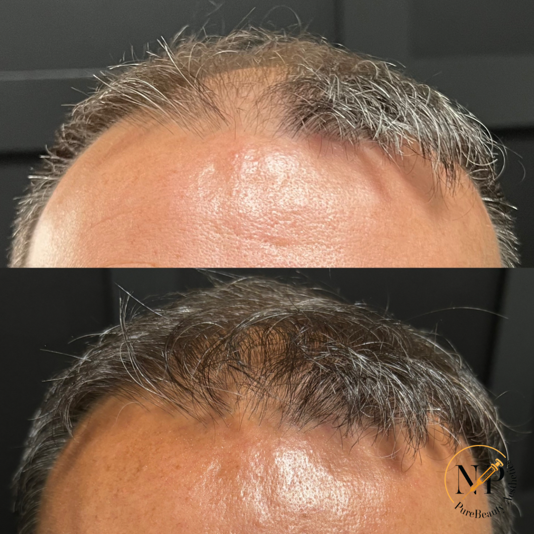 A man 's head is shown before and after a hair transplant.