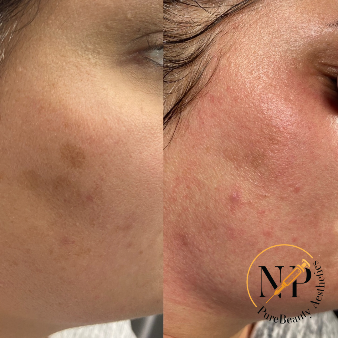 A woman 's face is shown before and after a treatment.