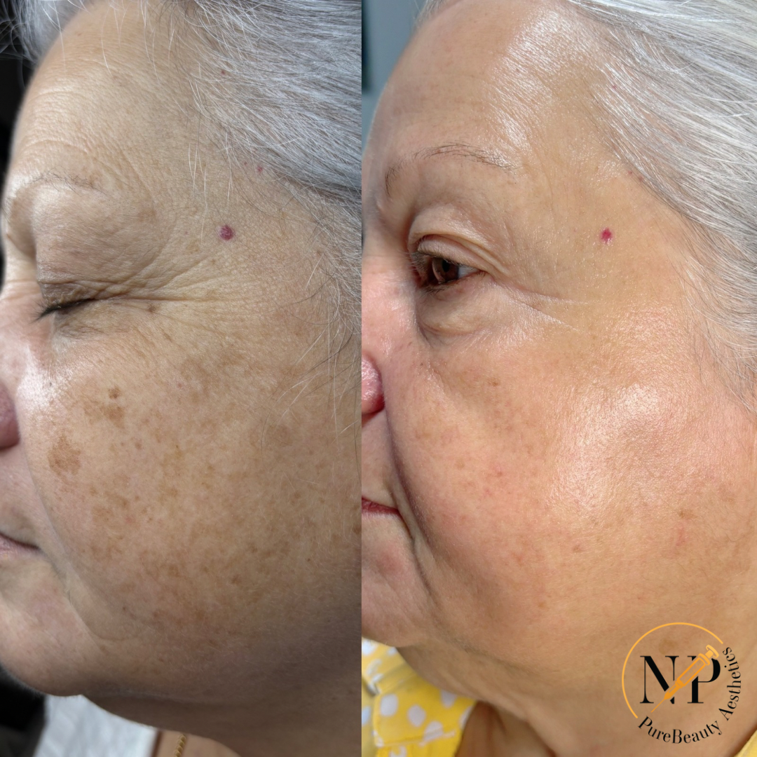 A before and after photo of an older woman 's face.