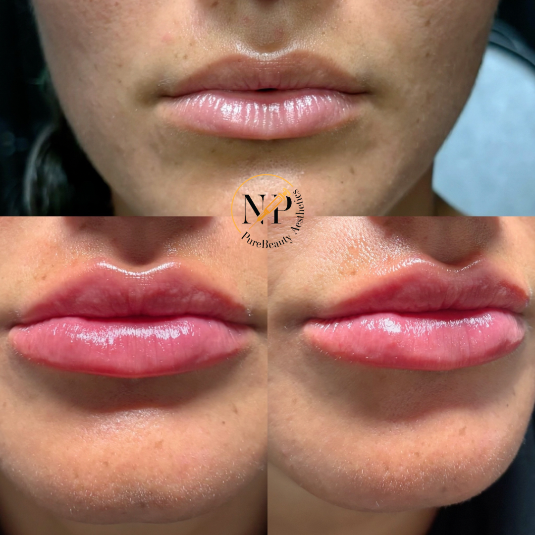 A before and after photo of a woman 's lips.