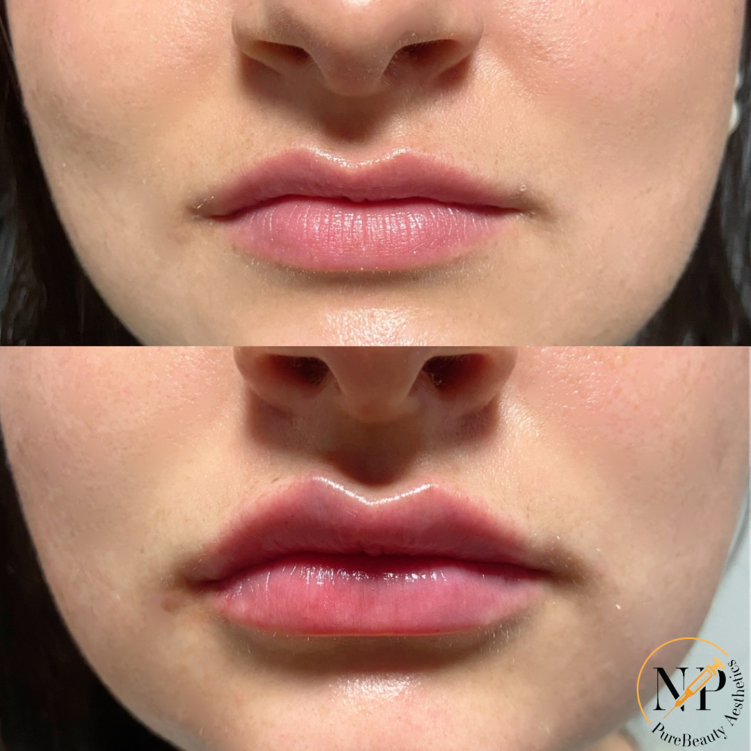 A before and after photo of a woman 's lips.