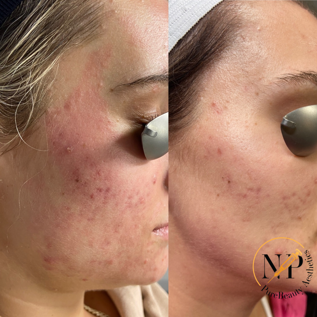 A before and after photo of a woman 's face with acne.