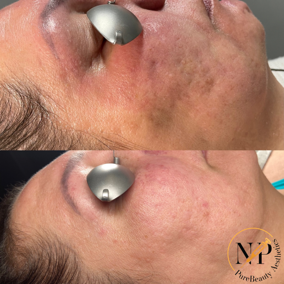 A woman 's face is shown before and after a treatment.