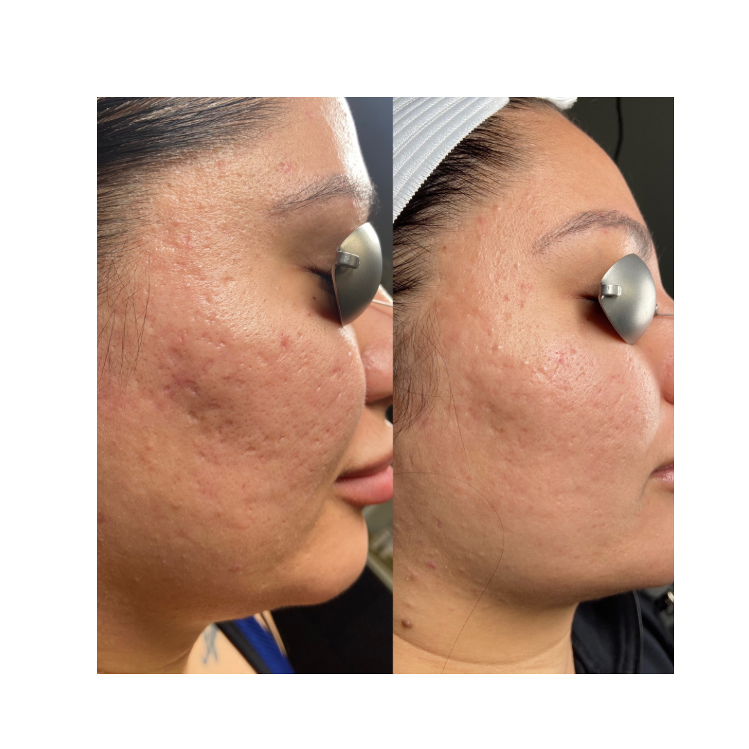 A before and after photo of a woman 's face with acne.