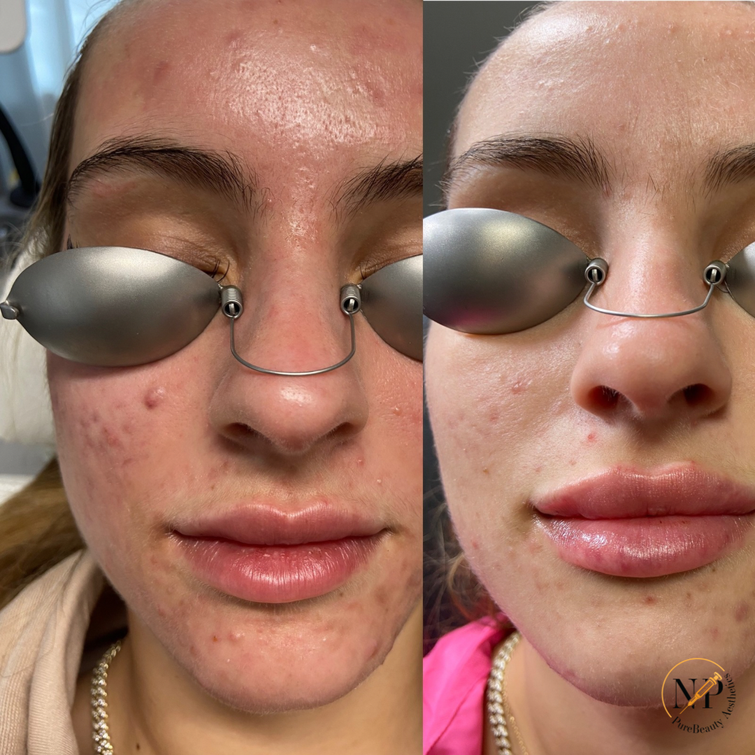 A woman 's face before and after wearing sunglasses.