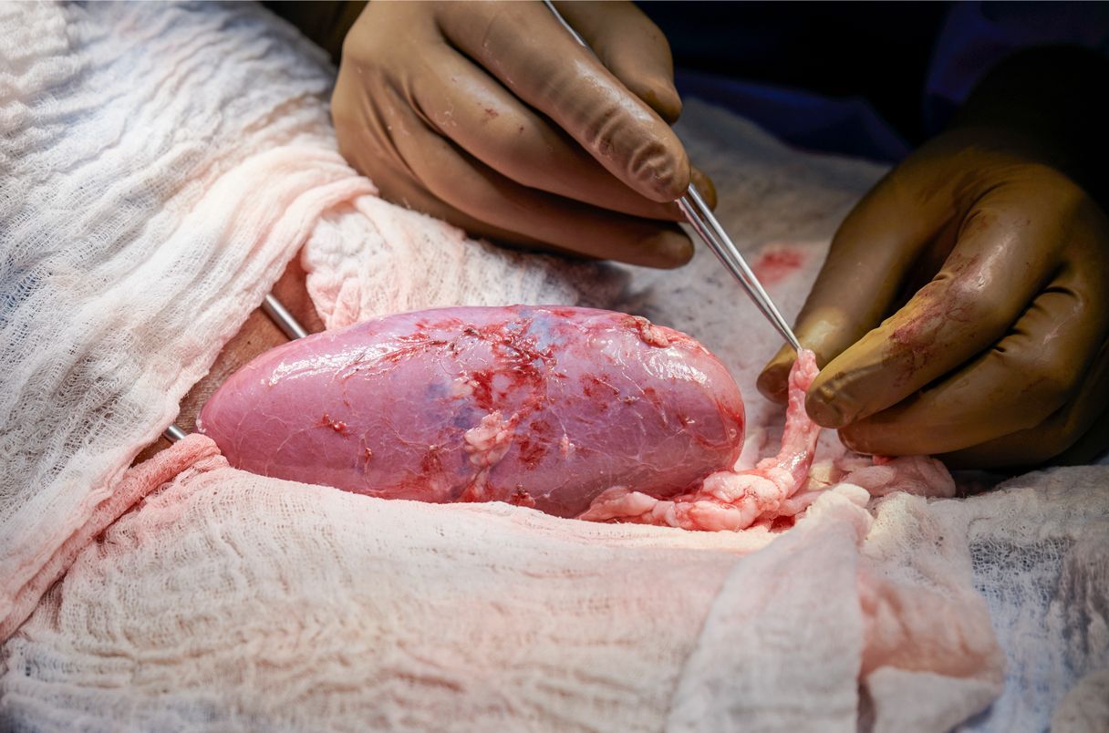 n engineered pig’s kidney was attached last month to the circulation of a brain-dead person.