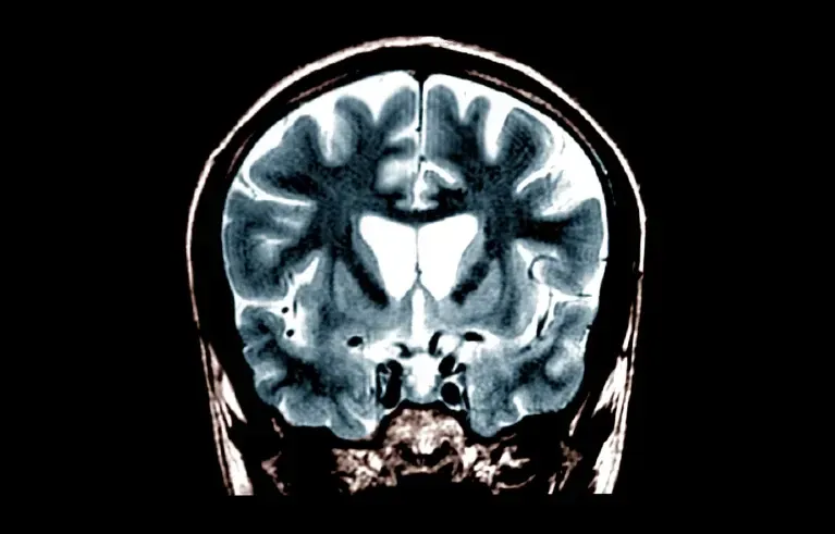 A brain scan of a person with Huntington’s disease
