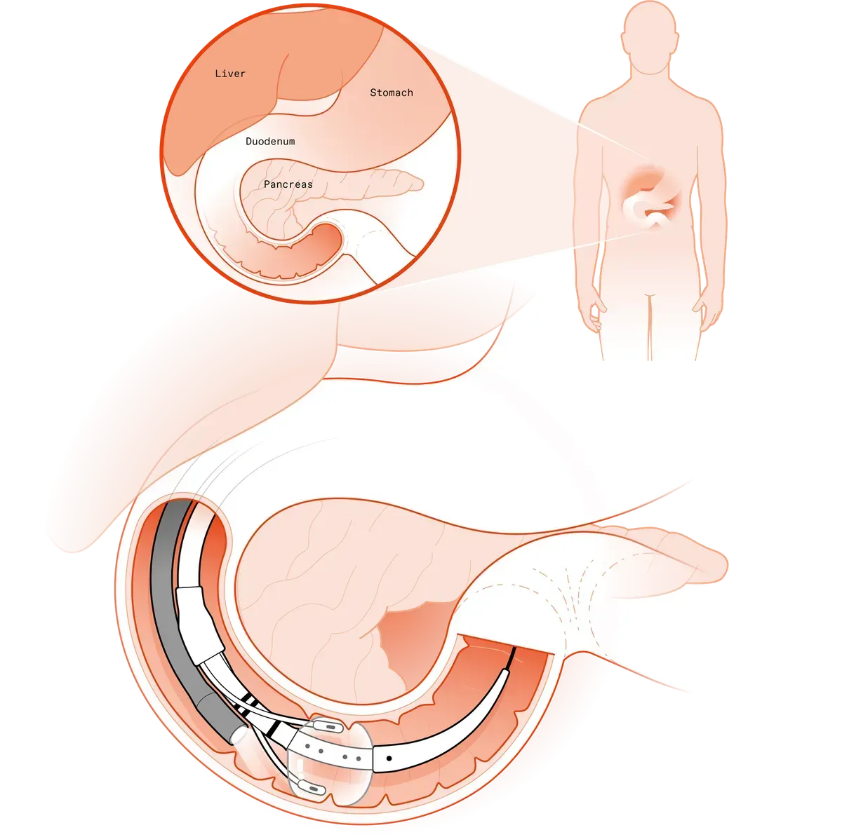 Illustration of duodenal mucosal resurfacing device inside the intestines