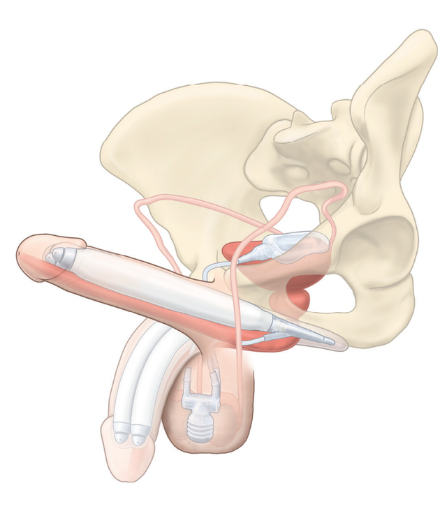 penisring app gesteuert Erektionsstörungen - Impotenz | Urologe und Androloge main image 0