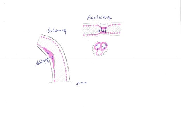 Peyronies disease, Morbus Peyronie, IPP, Penisverkmmung,  Schwellkrperverkrmmung, Plaques am Penis. Therapiemglichekeiten  Stowellentherapie, ESWT. Streckapparate