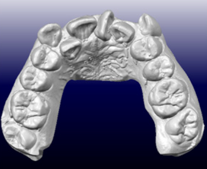 Digital intraoral scan for veneers at Leominster office