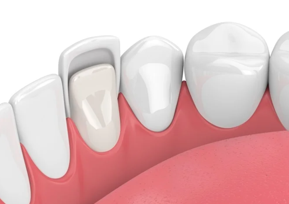 Dentist bonding veneers at Hallmark Dental Leominster