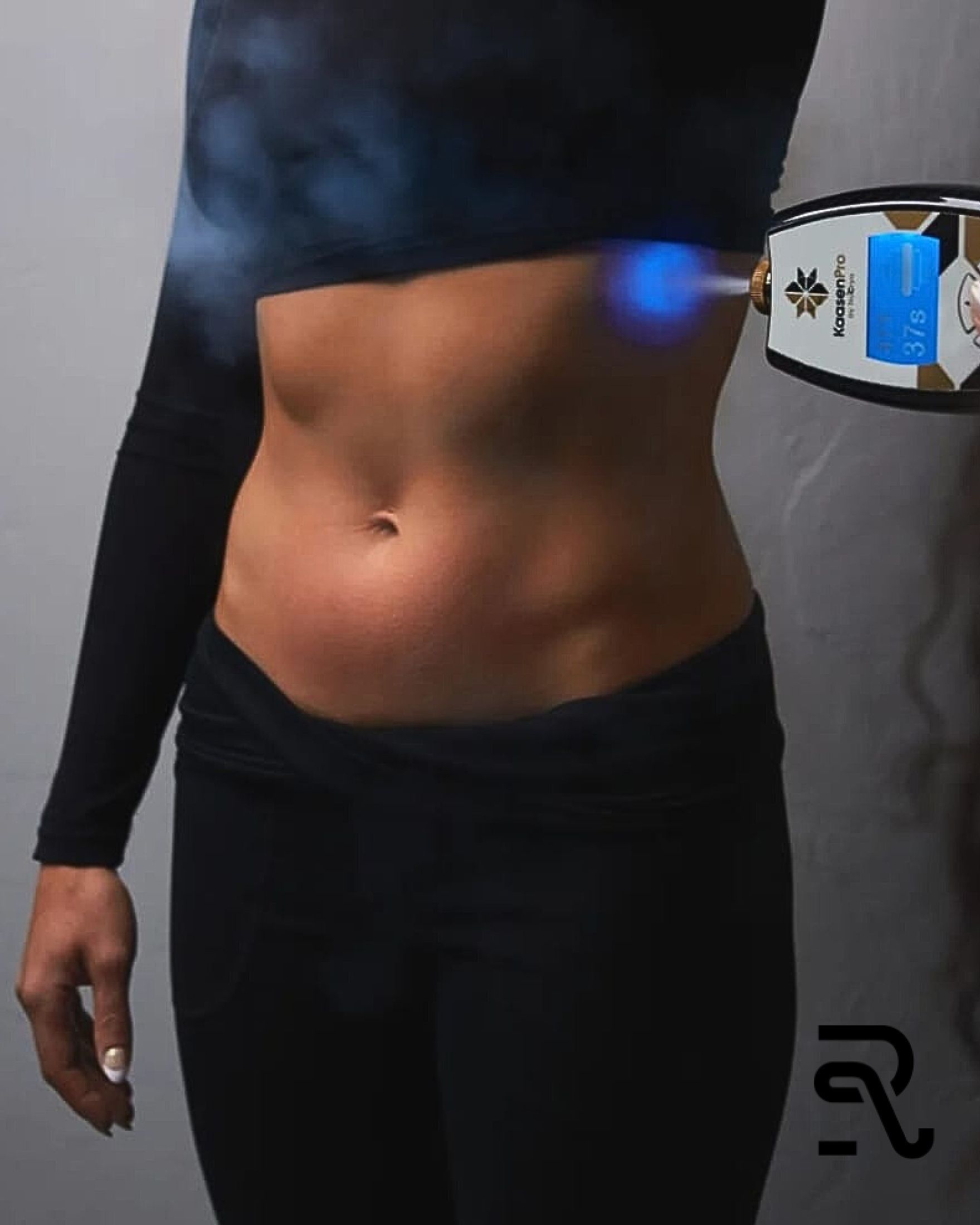 Woman receiving cryotherapy on abdomen with a device emitting blue light and vapor.