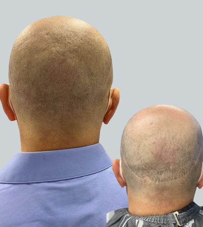 A man with a shaved head and another man with a shaved head