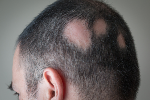 A man with a bald spot on his head.