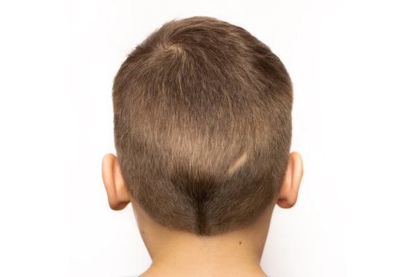 boy facing away, scar on scalp