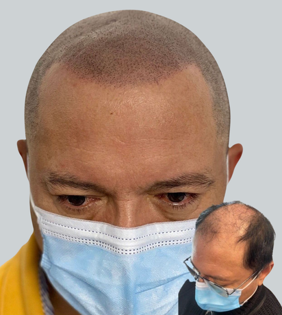 A man wearing a face mask has a bald head