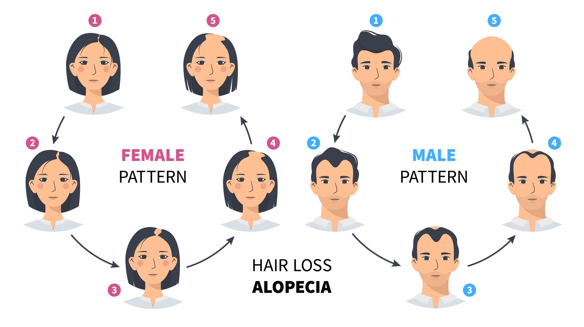 A diagram of female and male hair loss patterns.