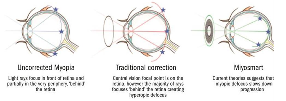 An image that shows how myopia can be corrected using special Hoya Miyosmart lenses.
