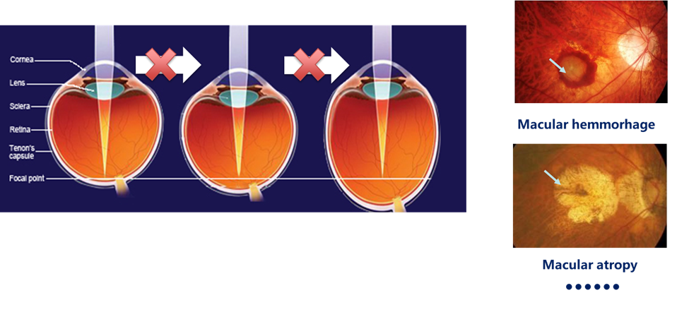 Cross-section image of an eyeball. 