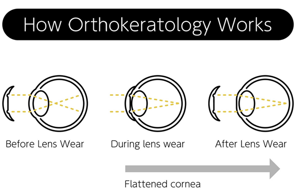 An illustration that shows how Orthokeratology works to reshape the cornea