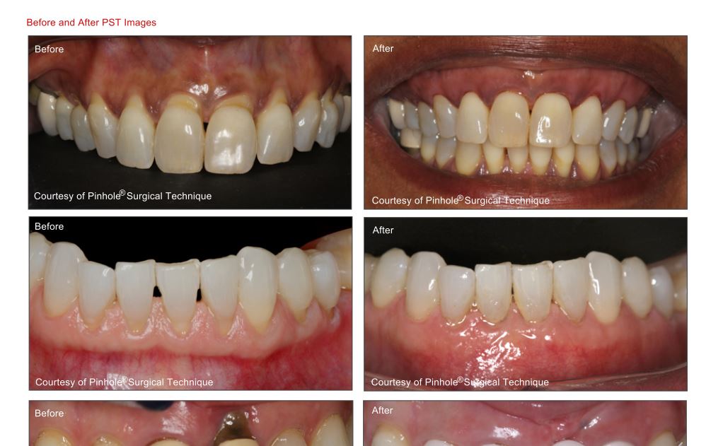 Picture Of Different Kinds Of Teeth — Naples, FL — Bradley Piotrowski, DDS, MSD, LLC
