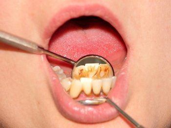 Checking Up The Teeth — Naples, FL — Bradley Piotrowski, DDS, MSD, LLC
